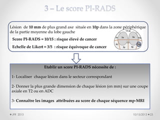 Lésion de 10 mm de plus grand axe située en 10p dans la zone périphérique
de la partie moyenne du lobe gauche
Score PI-RADS = 10/15 : risque élevé de cancer
Echelle de Likert = 3/5 : risque équivoque de cancer

Etablir un score PI-RADS nécessite de :
1- Localiser chaque lésion dans le secteur correspondant
2- Donner la plus grande dimension de chaque lésion (en mm) sur une coupe
axiale en T2 ou en ADC
3- Connaître les images attribuées au score de chaque séquence mp-MRI
JFR 2013

10/15/2013

23

 