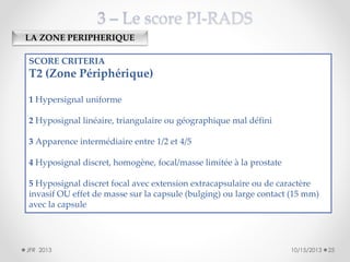 LA ZONE PERIPHERIQUE
SCORE CRITERIA

T2 (Zone Périphérique)
1 Hypersignal uniforme
2 Hyposignal linéaire, triangulaire ou géographique mal défini
3 Apparence intermédiaire entre 1/2 et 4/5
4 Hyposignal discret, homogène, focal/masse limitée à la prostate
5 Hyposignal discret focal avec extension extracapsulaire ou de caractère
invasif OU effet de masse sur la capsule (bulging) ou large contact (15 mm)
avec la capsule

JFR 2013

10/15/2013

25

 