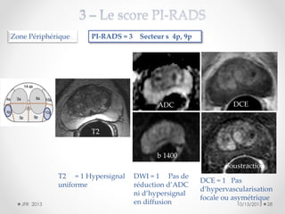 Zone Périphérique

PI-RADS = 3 Secteur s 4p, 9p

ADC

DCE

T2
b 1400

Soustraction
T2 = 1 Hypersignal
uniforme
JFR 2013

DWI = 1 Pas de
réduction d’ADC
ni d’hypersignal
en diffusion

DCE = 1 Pas
d’hypervascularisation
focale ou asymétrique
10/15/2013

28

 