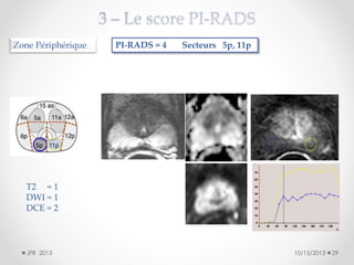 Zone Périphérique

PI-RADS = 4

Secteurs 5p, 11p

T2 = 1
DWI = 1
DCE = 2

JFR 2013

10/15/2013

29

 