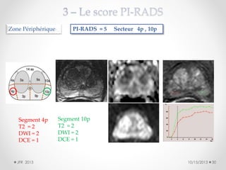 Zone Périphérique

Segment 4p
T2 = 2
DWI = 2
DCE = 1

JFR 2013

PI-RADS = 5

Secteur 4p , 10p

Segment 10p
T2 = 2
DWI = 2
DCE = 1

10/15/2013

30

 