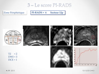 Zone Périphérique

PI-RADS = 6

Secteur 12p

T2 = 2
DWI = 3
DCE = 1

JFR 2013

10/15/2013

31

 