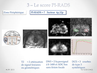 Zone Périphérique

JFR 2013

PI-RADS = 7 Secteur 6p,12p

T2 = 2 atténuation
de signal linéaires
ou géométriques

DWI = 2 hypersignal
à b 1400 et ADC bas
sans lésion focale

DCE = 3 courbes
de type 3
symétriques
10/15/2013

32

 