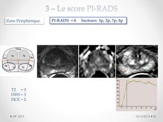 Zone Périphérique

PI-RADS = 8

Secteurs 1p, 2p, 7p, 8p

T2 = 3
DWI = 3
DCE = 2

JFR 2013

10/15/2013

33

 