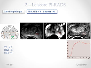 Zone Périphérique

PI-RADS = 9 Secteur 9p

T2 = 2
DWI = 3
DCE = 4

JFR 2013

10/15/2013

34

 