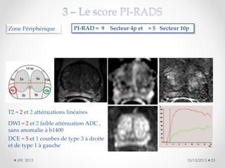 Zone Périphérique

PI-RAD = 9 Secteur 4p et = 5 Secteur 10p

T2 = 2 et 2 atténuations linéaires
DWI = 2 et 2 faible atténuation ADC ,
sans anomalie à b1400
DCE = 5 et 1 courbes de type 3 à droite
et de type 1 à gauche
JFR 2013

10/15/2013

35

 