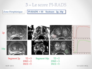 Zone Périphérique

PI-RADS = 10 Secteurs 2p, 10p

2p

10p

Segment 2p
JFR 2013

T2 = 3
DWI = 2
DCE = 5

Segment 10p

T2 = 2
DWI = 3
DCE = 5

10/15/2013

36

 