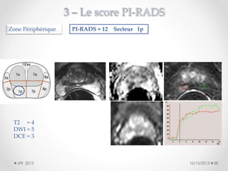 Zone Périphérique

PI-RADS = 12 Secteur 1p

T2 = 4
DWI = 5
DCE = 3

JFR 2013

10/15/2013

38

 
