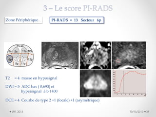 Zone Périphérique

T2

PI-RADS = 13 Secteur 6p

= 4 masse en hyposignal

DWI = 5 ADC bas ( 0,693) et
hypersignal à b 1400
DCE = 4 Courbe de type 2 +1 (focale) +1 (asymétrique)
JFR 2013

10/15/2013

39

 