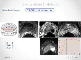 Zone Périphérique

PI-RADS = 14 Secteur 8p

T2 = 4
DWI = 5
DCE = 5

JFR 2013

10/15/2013

40

 