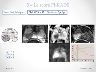 Zone Périphérique

PI-RADS = 15

Secteurs 5p, 6p

T2 = 5
DWI = 5
DCE = 5

JFR 2013

10/15/2013

41

 