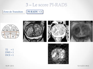 Zone de Transition

PI-RADS = 3

T2 = 1
DWI = 1
DCE = 1

JFR 2013

10/15/2013

43

 