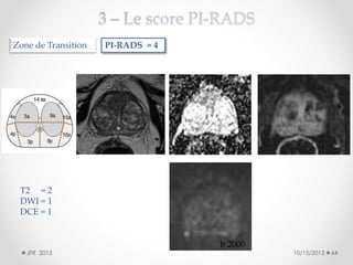 Zone de Transition

PI-RADS = 4

T2 = 2
DWI = 1
DCE = 1

JFR 2013

b 2000

10/15/2013

44

 