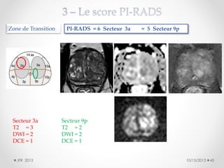 Zone de Transition

Secteur 3a
T2 = 3
DWI = 2
DCE = 1
JFR 2013

PI-RADS = 6 Secteur 3a

= 5 Secteur 9p

Secteur 9p
T2 = 2
DWI = 2
DCE = 1
10/15/2013

45

 