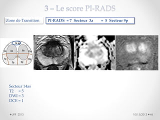 Zone de Transition

PI-RADS = 7 Secteur 3a

= 5 Secteur 9p

Secteur 14as
T2 = 5
DWI = 3
DCE = 1
JFR 2013

10/15/2013

46

 