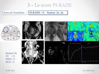 Zone de Transition

PI-RADS = 9 Secteur 3a , 4a

Secteur 3a
T2 = 5
DWI = 3
DCE = 1
JFR 2013

10/15/2013

47

 