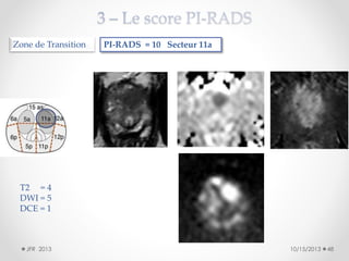 Zone de Transition

PI-RADS = 10 Secteur 11a

T2 = 4
DWI = 5
DCE = 1

JFR 2013

10/15/2013

48

 