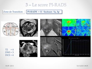 Zone de Transition

PI-RADS = 11 Secteurs 5a, 5p

T2 = 4
DWI = 3
DCE = 4

JFR 2013

10/15/2013

49

 