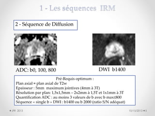 2 - Séquence de Diffusion

ADC: b0, 100, 800

DWI b1400

Pré-Requis optimum :
Plan axial ≡ plan axial de T2w
Epaisseur : 5mm maximum jointives (4mm à 3T)
Résolution par plan: 1,5x1,5mm – 2x2mm à 1,5T et 1x1mm à 3T
Quantification ADC : au moins 3 valeurs de b avec b max≤800
Séquence « single b » DWI : b1400 ou b 2000 (ratio S/N adéquat)
JFR 2013

10/15/2013

5

 