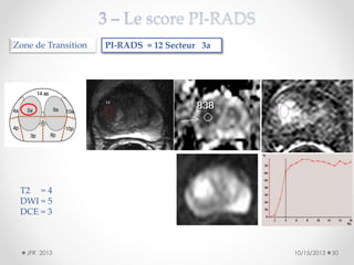 Zone de Transition

PI-RADS = 12 Secteur 3a

T2 = 4
DWI = 5
DCE = 3

JFR 2013

10/15/2013

50

 