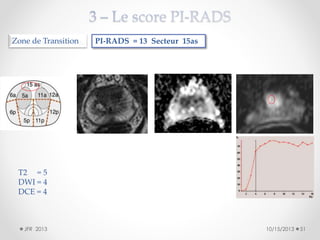 Zone de Transition

PI-RADS = 13 Secteur 15as

T2 = 5
DWI = 4
DCE = 4

JFR 2013

10/15/2013

51

 