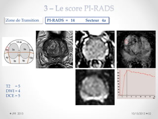 Zone de Transition

PI-RADS = 14

Secteur 4a

T2 = 5
DWI = 4
DCE = 5

JFR 2013

10/15/2013

52

 