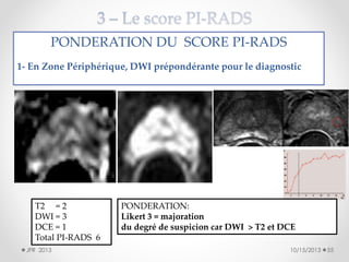PONDERATION DU SCORE PI-RADS
1- En Zone Périphérique, DWI prépondérante pour le diagnostic

T2 = 2
DWI = 3
DCE = 1
Total PI-RADS 6
JFR 2013

PONDERATION:
Likert 3 = majoration
du degré de suspicion car DWI > T2 et DCE
10/15/2013

55

 