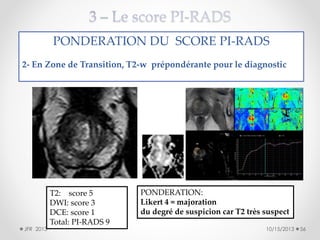 PONDERATION DU SCORE PI-RADS
2- En Zone de Transition, T2-w prépondérante pour le diagnostic

JFR 2013

T2: score 5
DWI: score 3
DCE: score 1
Total: PI-RADS 9

PONDERATION:
Likert 4 = majoration
du degré de suspicion car T2 très suspect
10/15/2013

56

 