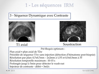 3 - Séquence Dynamique avec Contraste

T1 axial

Soustraction

Pré-Requis optimum :
Plan axial ≡ plan axial de T2w
Précédée de séquence T1w sans injection (détection d’hématome post-biopsie)
Résolution par plan: 0,7x0,7mm – 2x2mm à 1,5T et 0,5x0,5mm à 3T
Résolution temporelle maximum : 10-15 s
Prolongée jusqu’à 5min pour détecter le wash-out
Injecteur de contraste - débit = 3ml/s
JFR 2013

10/15/2013

6

 