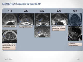 MEMENTO : Séquence T2 pour la ZP

1/5

Hypersignal normal

Nodule d’hyperplasie
bénin (encapsulé, en
hypersignal)

JFR 2013

2/5

Hyposignal linéaire

3/5

4/5

5/5

Masse focale en
hyposignal, limitée à
la prostate

Extension
extracapsulaire

62

 