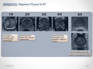 MEMENTO : Séquence T2 pour la ZT

1/5

Hypersignal
homogène, bien
limité (capsule
périphérique)

2/5

Hyposignal bien
limité, avec capsule
périphérique

3/5

4/5

5/5

Hyposignal plus
homogène, mal
délimité « effacé au
fusain »

Corne antérieure de la ZP
Lésion en hyposignal du SFMA

JFR 2013

63

 
