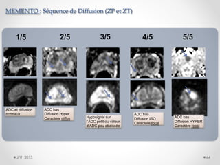 MEMENTO : Séquence de Diffusion (ZP et ZT)

1/5

ADC et diffusion
normaux

JFR 2013

2/5

ADC bas
Diffusion Hyper
Caractère diffus

3/5

Hyposignal sur
l’ADC petit ou valeur
d’ADC peu abaissée

4/5

ADC bas
Diffusion ISO
Caractère focal

5/5

ADC bas
Diffusion HYPER
Caractère focal

64

 