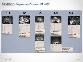 MEMENTO : Séquence de Perfusion (ZP et ZT)

1/5

Courbe type 1

2/5

Courbe type 2
Symétrique
Non focale

3/5

Courbe type 2
Asymétrique
Non focale

Courbe type 3
Symétrique Non
focale

JFR 2013

4/5

Courbe type 2
Focale
Asymétrique

5/5

Courbe type 3
Focale
Asymétrique

Courbe type 3
Asymétrique
Non focale

65

 