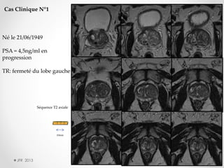 Cas Clinique N°1

Né le 21/06/1949
PSA = 4,5ng/ml en
progression
TR: fermeté du lobe gauche

Séquence T2 axiale

10mm

JFR 2013

10/15/2013

68

 