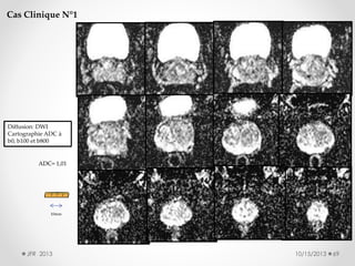 Cas Clinique N°1

Diffusion: DWI
Cartographie ADC à
b0, b100 et b800

ADC= 1,01

10mm

JFR 2013

10/15/2013

69

 
