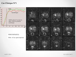 Cas Clinique N°1
Cible
Symétrique

2 ROI’s placés l’un dans la
cible, l’autre en position
symétrique

PERFUSION(DCE)
Délai: 42 sec après injection

JFR 2013

10/15/2013

71

 