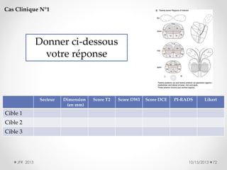 Cas Clinique N°1

Donner ci-dessous
votre réponse

Secteur

Dimension
(en mm)

Score T2

Score DWI

Score DCE

PI-RADS

Likert

Cible 1
Cible 2
Cible 3

JFR 2013

10/15/2013

72

 