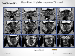 Cas Clinique N°2

77 ans, PSA = 15 ng/ml en progression, TR: normal

Séquence T2 axiale
JFR 2013

10mm

10/15/2013

73

 