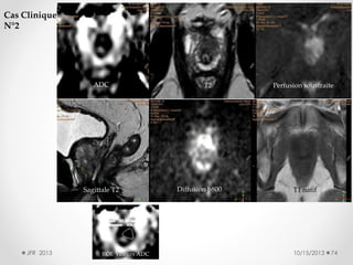 Cas Clinique
N°2

ADC

Sagittale T2

JFR 2013

ROI: Valeurs ADC

T2

Diffusion b800

Perfusion soustraite

T1 natif

10/15/2013

74

 