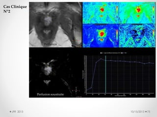 Cas Clinique
N°2

Perfusion

Perfusion soustraite

JFR 2013

10/15/2013

75

 
