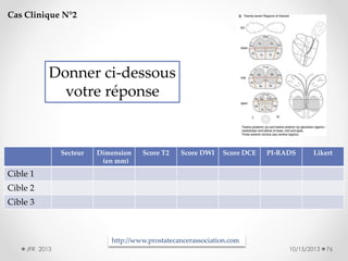 Cas Clinique N°2

Donner ci-dessous
votre réponse

Secteur

Dimension
(en mm)

Score T2

Score DWI

Score DCE

PI-RADS

Likert

Cible 1
Cible 2
Cible 3

http://www.prostatecancerassociation.com
JFR 2013

10/15/2013

76

 