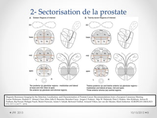 2- Sectorisation de la prostate

Magnetic Resonance Imaging for the Detection, Localisation, and Characterisation of Prostate Cancer: Recommendations from a European Consensus Meeting
Louise Dickinson, Hashim U. Ahmed, Clare Allen, Jelle O. Barentsz, Brendan Carey , Jurgen J. Futterer , Stijn W. Heijmink, Peter J. Hoskin, Alex Kirkham, Anwar R.
Padhani, Raj Persad, Philippe Puech, Shonit Punwani, Aslam S. Sohaib, Bertrand Tombal, Arnauld Villers, Jan van der Meulen, Mark Emberton EUROPEAN UROLOGY
59(2011)477–494

JFR 2013

10/15/2013

8

 