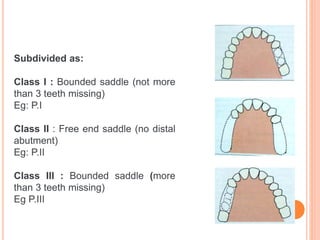 Craddock Classification Rpd classification RPD.pptx