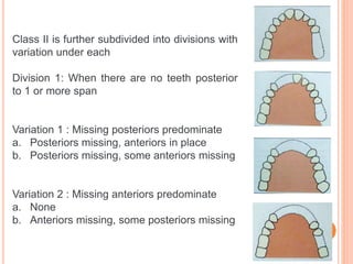 Class 2 Mod 2 Rpd classification RPD.pptx