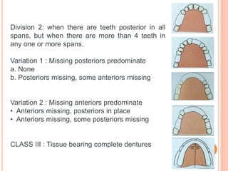 Craddock Classification Rpd classification RPD.pptx