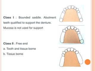 classification RPD.pptx
