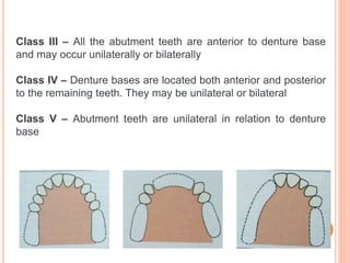 classification RPD.pptx