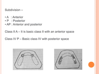Type Iv Rpd classification RPD.pptx