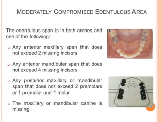 Edentulous Class Rpd classification RPD.pptx