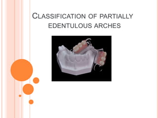 CLASSIFICATION OF PARTIALLY
EDENTULOUS ARCHES
 